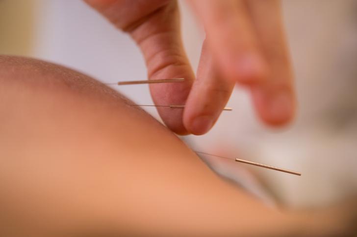 acupuncture needles