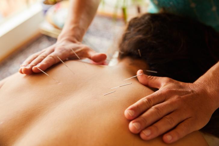 accupuncture 