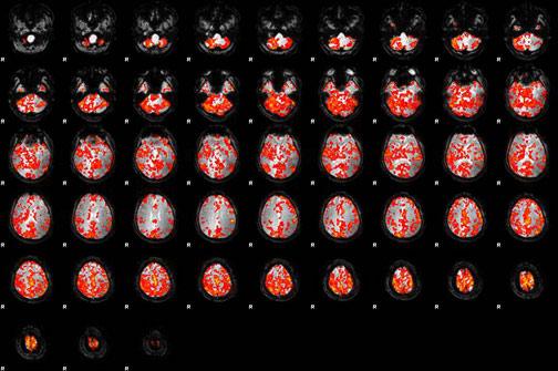 fmri brain scan 